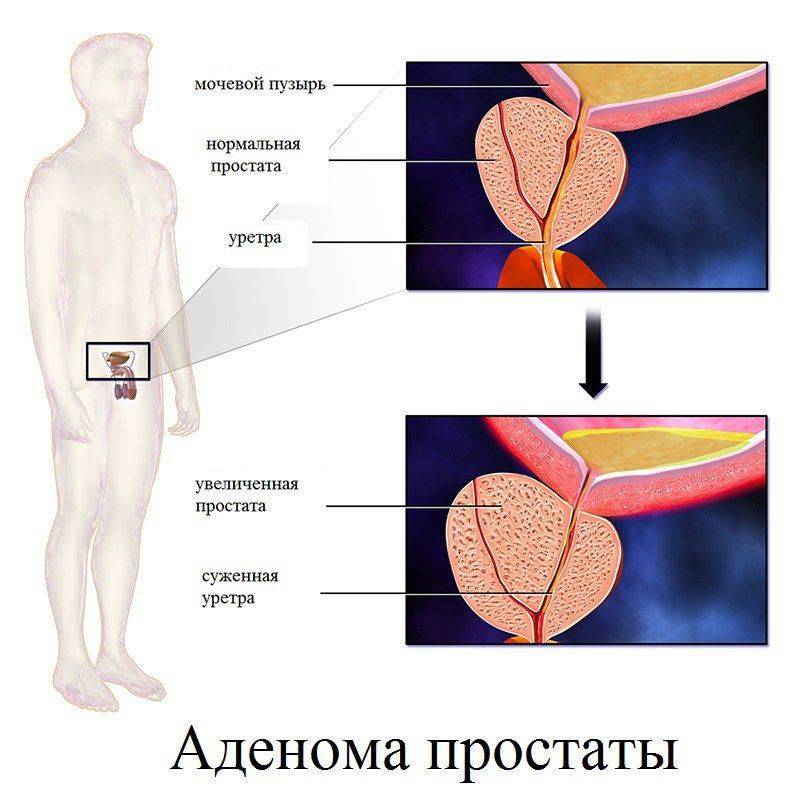 Виды операций по удалению аденомы предстательной железы