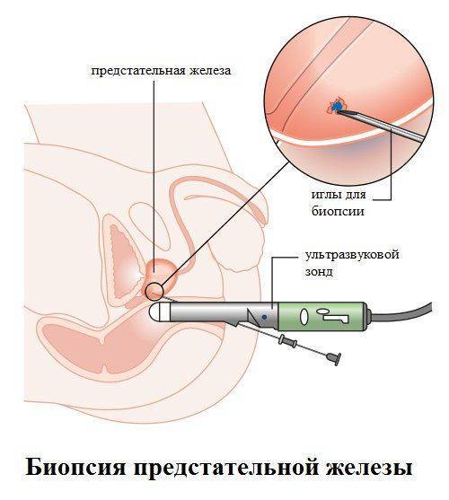 Схема биопсии предстательной железы