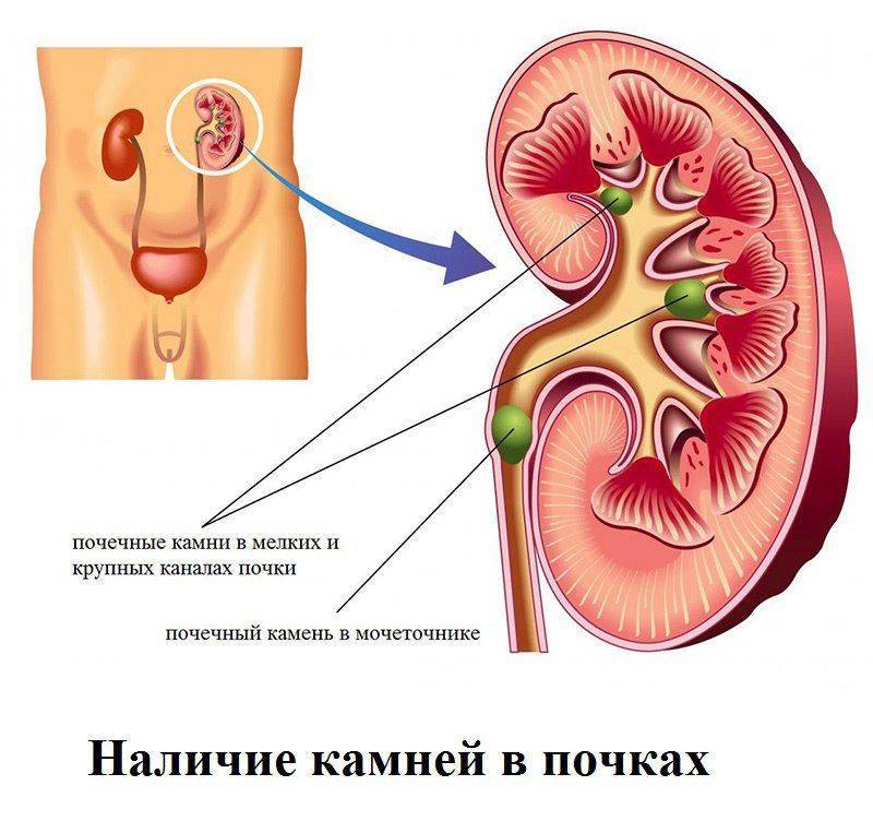Почечные колики симптомы лечение в домашних условиях Почечные колики симптомы лечение в домашних условиях