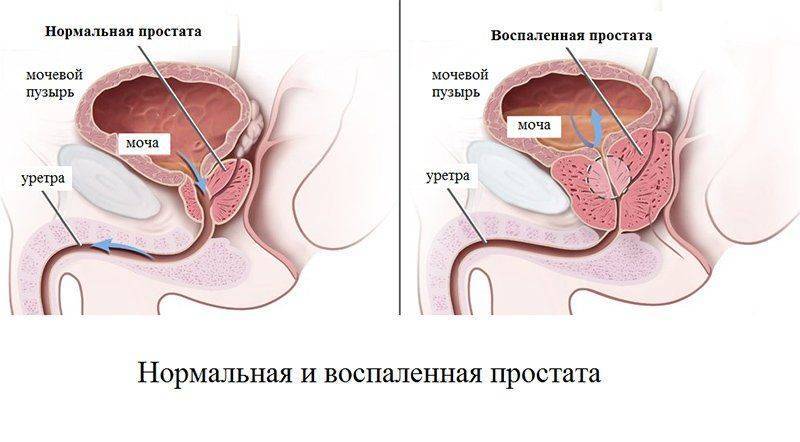 Нормальные размеры простат Нормальные размеры простат