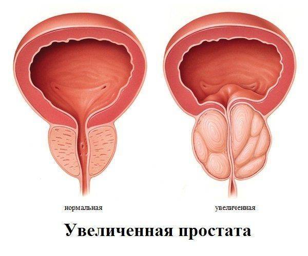 Увеличенная простата