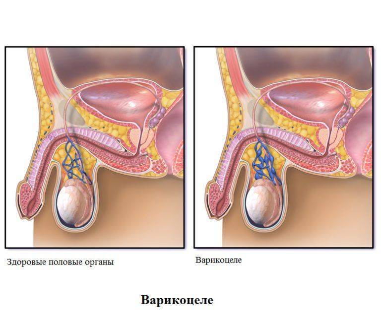 Варикоз Операция У Мужчин