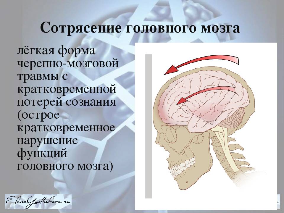 Сотрясение головного мозга – симптомы, признаки, первая помощь, степени повреждения