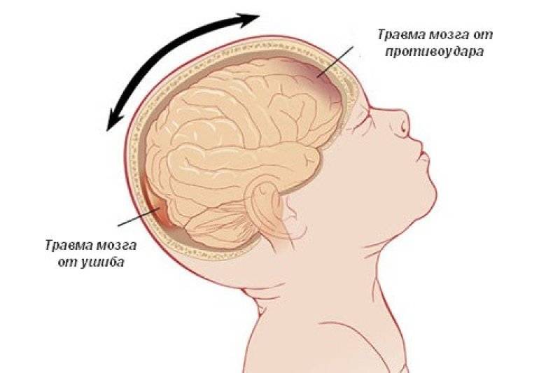 Чем опасно легкое сотрясение головного мозга и каковы могут быть его последствия?