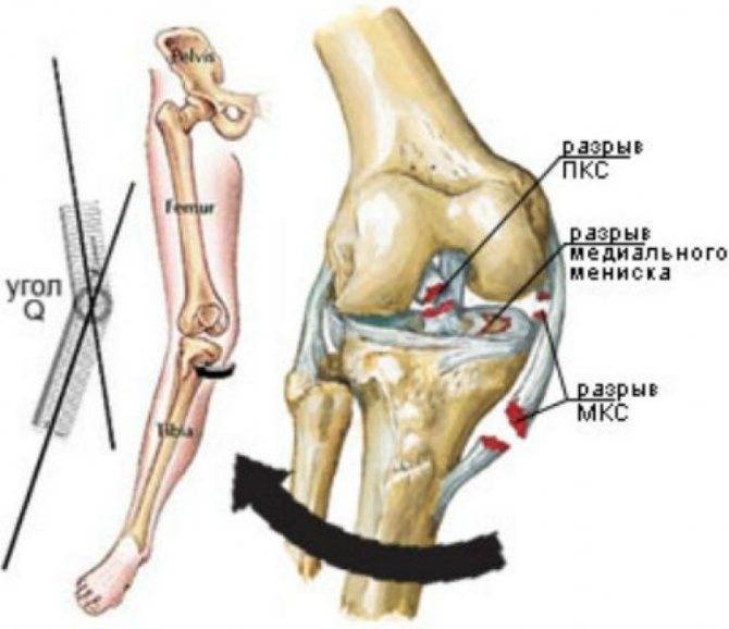 Опасен ли разрыв связок коленного сустава?