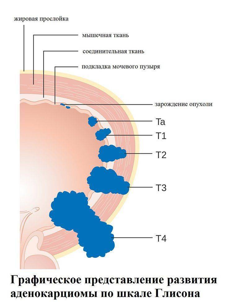Ацинарная аденокарцинома предстательной железы глисон 7
