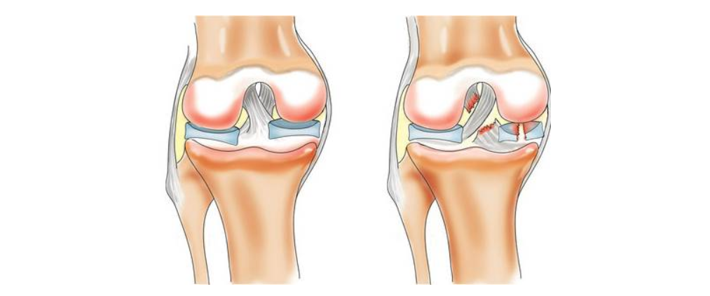 Самое важное про растяжение связок коленного сустава: симптомы и лечение