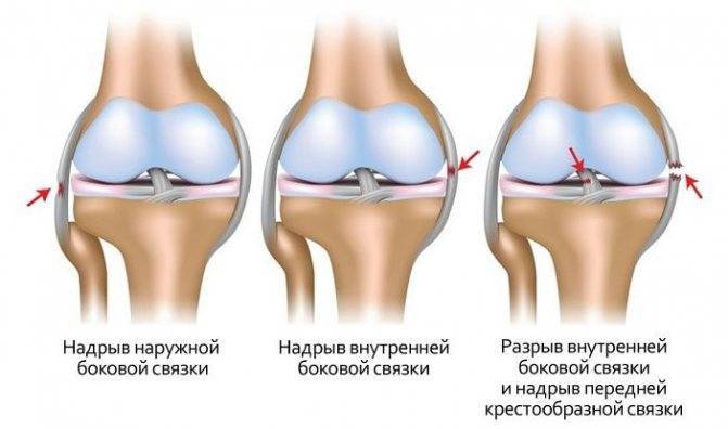 Повреждение связок колена: симптомы и лечение