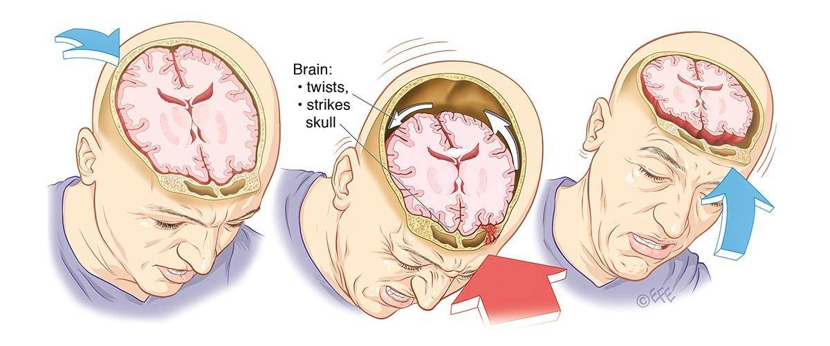 Последствия после сотрясения головного мозга