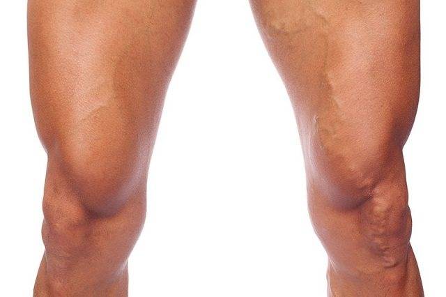 Упражнения при варикозе ног. польза и противопоказания