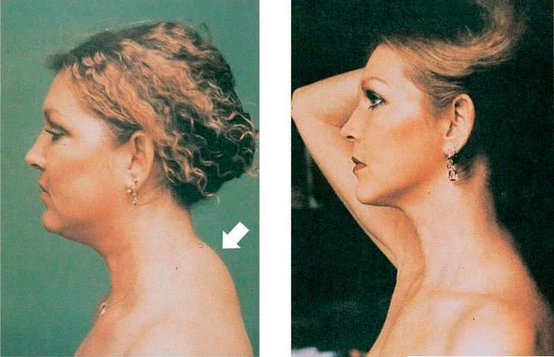 Холка на шее у женщин: причины и лечение, как избавиться, массаж