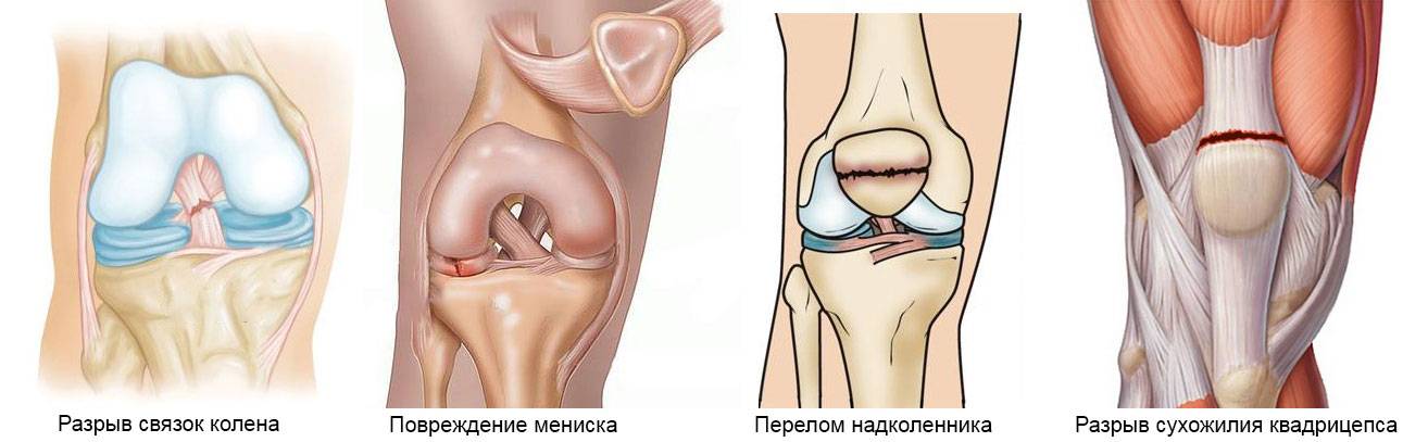 Растяжение связок колена (лечение) — sportwiki энциклопедия