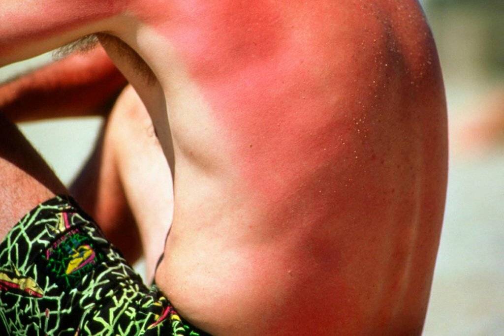 13 мифов о солнечных ожогах, которые вредят вашей коже