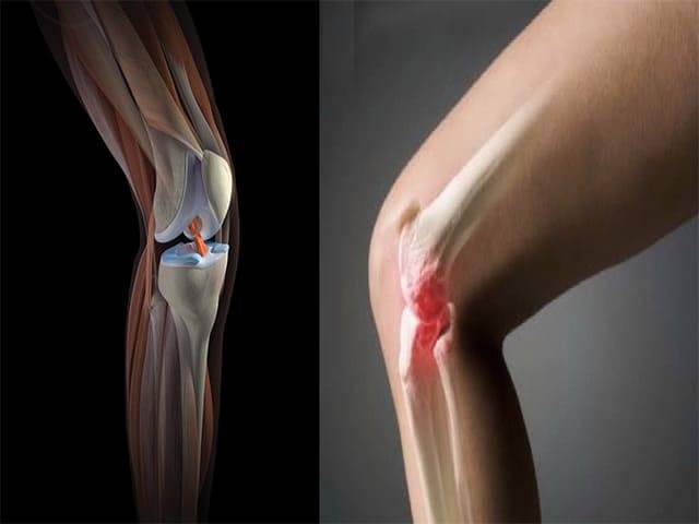 Виды закрытых травм колена – симптомы травм коленного сустава и первая помощь пострадавшему