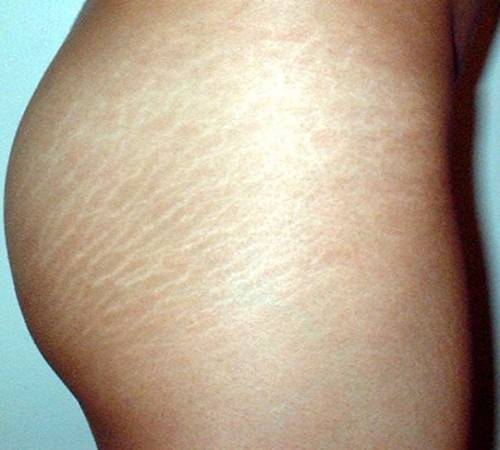 Растяжки на коже: причины появления и лечение стрий