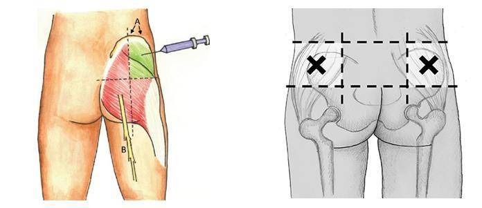 Как правильно делать внутримышечные инъекции: определение мест постановки внутримышечных уколов (+ инфографика)