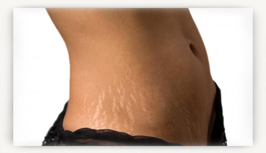 Растяжки на коже (стрии) — причины появления и способы лечения