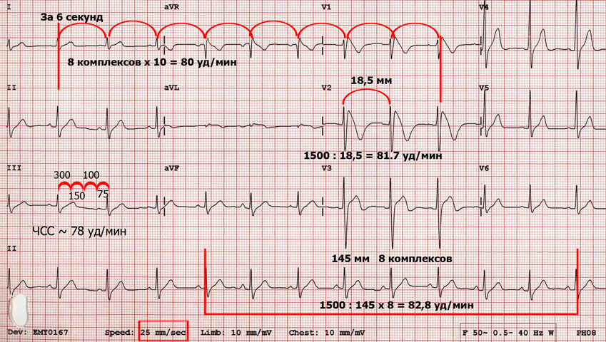 Чсс по экг. Пульс 300 ударов на ЭКГ. Кардиограмма при низком давлении. Низкий пульс кардиограмма. ЧСС 300 В минуту это на ЭКГ.