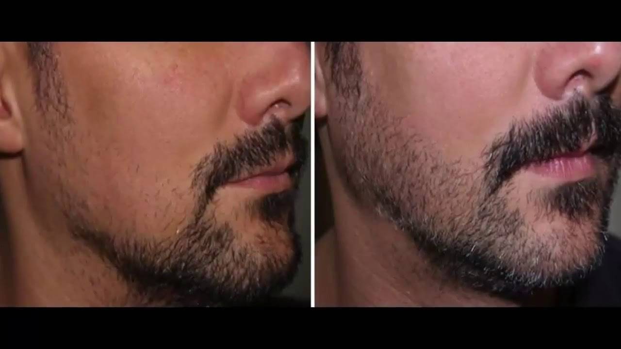 Как быстро отрастить бороду в домашних условиях за неделю?