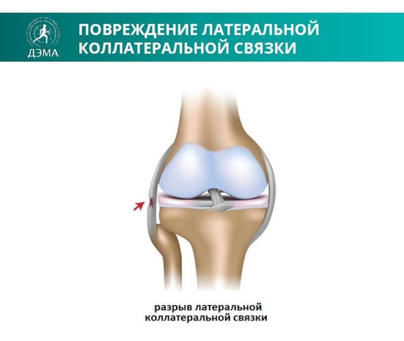 Надрыв связок коленного сустава – лечение, сроки реабилитации