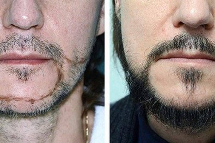 Недорогие способы сделать бороду более густой