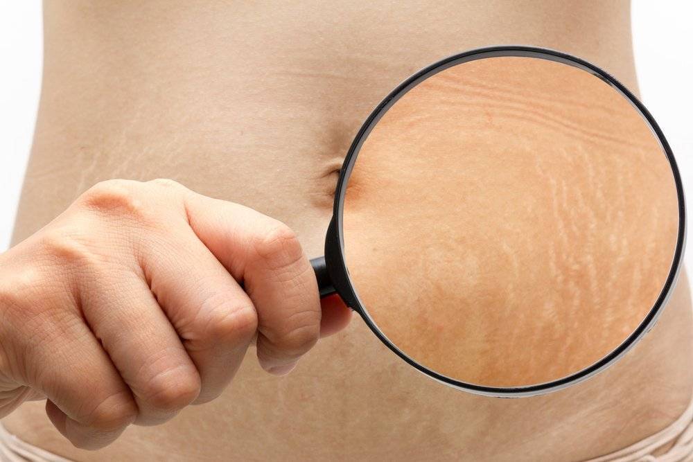 Стрии (растяжки на коже): причины появления, способы лечения