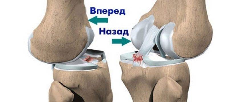 Растяжение связок колена (лечение)