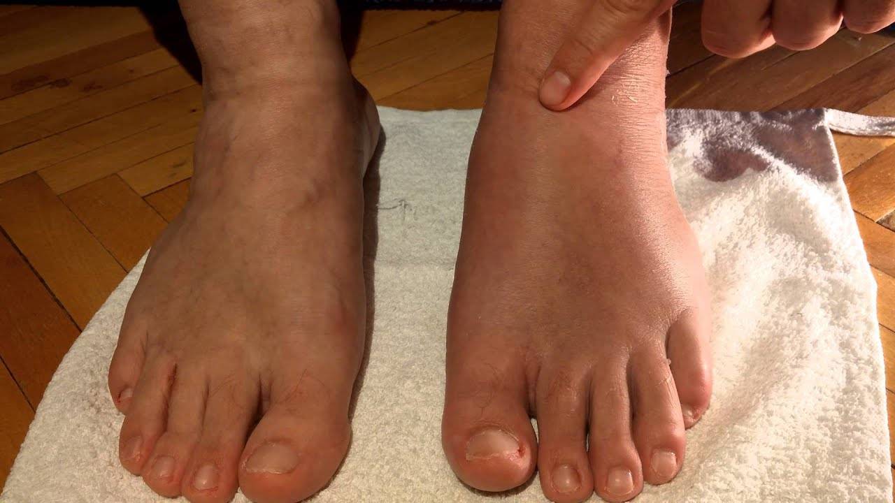 Простые и эффективные способы лечения растяжения связок голеностопа: как быстро избавиться от боли и отека ноги в домашних условиях