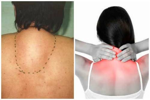 Холка на шее у женщин: причины и лечение, как избавиться, массаж