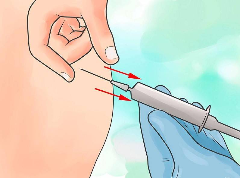 Как сделать внутримышечный укол: подробная инструкция как поставить укол правильно (125 фото + видео)