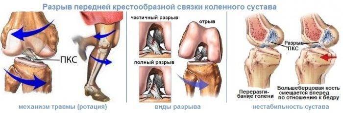 Повреждение коленного сустава: диагностика и лечение