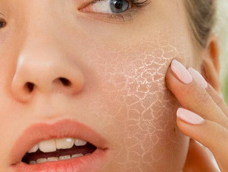 Сухая кожа лица: причины сухости, как бороться с сухой кожей лица?